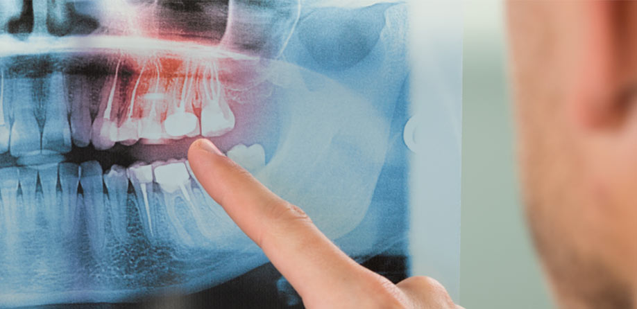 X Rays and Your Teeth