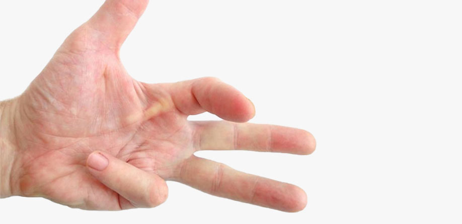 Do You Know About Dupuytren’s Contracture?